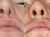 1a-cleft-lip-and-palate