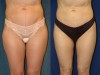 1a-liposuction