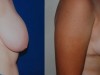 1a-breast-reduction