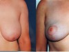 1b-breast-reduction