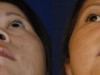 2a-augmentation-rhinoplasty