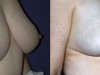 2b-breast-reduction