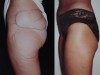 3a-liposuction