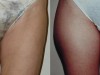 3b-liposuction-