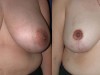 4a-breast-reduction