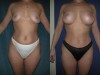 4b-liposuction