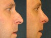 4b-nose-surgery
