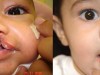 5a-cleft-lip-and-palate