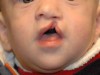 6a-cleft-lip-and-palate